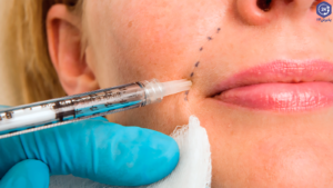 راهنمای کامل انواع تزریق فیلر به صورت